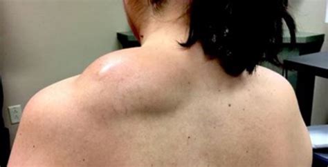 Huge boil popping on back. The coronavirus pandemic closed doctor's offices at the beginning of the year, but Dr. Pimple Popper was able to see her patients again in May and resumed sharing videos of her procedures. The best pimple-popping videos of 2020 include a "bubble-wrap" lipoma, "potato salad" back cyst, and a man with a "mask" of blackheads around his nose ... 