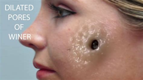 Huge dilated pore. Baby Fraxel refines pores. Non-ablative 1440 nm diode fractional laser – Clear and Brilliant , which we refer to as our Baby Fraxel – is useful in treatment of enlarged facial pores. This treatment is triple-benefit with skin smoothing, collagen encouragement and pore minimizing. The optional inclusion of Permea improves discoloration. 