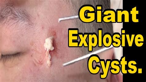 Huge explosive cysts. 😄 Extractor Kit: https://amzn.to/2O5PMi6😄 RESTMORE (30 Day): https://amzn.to/32KhQM3😄 Thinergy (60 Fay): https://amzn.to/3gfaY21RESTMOR... 