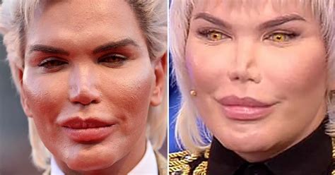 Human Ken Doll’s nose is collapsing AGAIN as he finally ... - The Sun