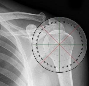 Humeral Head to Greater Tuberosity Angle Study