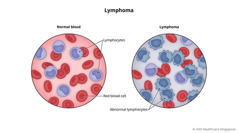 Humira and lymphoma. Some children and adolescents have developed certain types of cancer when taking Humira, such as lymphoma. (This is a type of cancer that affects the … 