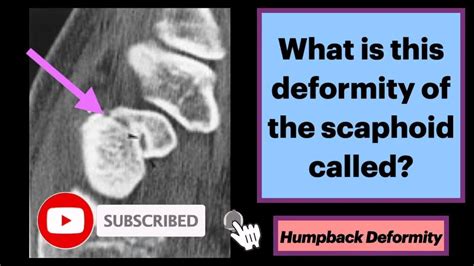 Humpback Deformity of the Scaphoid - YouTube