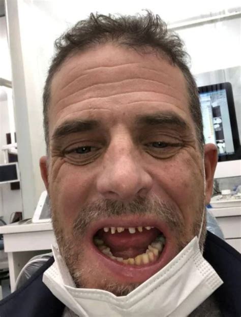 The saddest picture published in the news report is one showing Hunter Biden showing his teeth, ravaged by drug use, to the camera. Thanks to the New York Post (NYP), accurate reports on the .... 