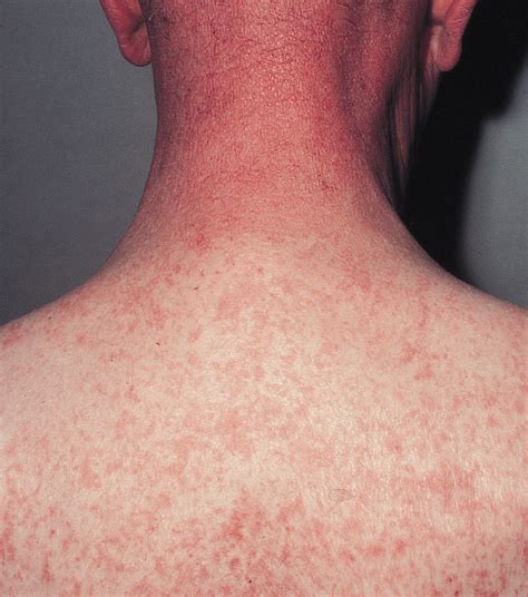 Hydrochlorothiazide and Photosensitive rash, a phase IV clinical …