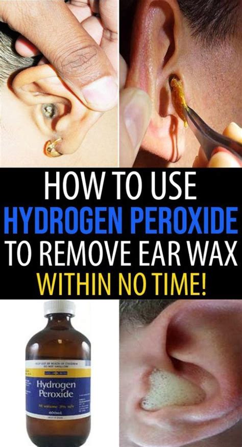 Hydrogen peroxide blackheads in ear. When a pore becomes clogged, the sebaceous gland doesn't stop producing oil. The pore can get so full it ruptures the walls. The bacteria from the pore enters the bloodstream, causing an infection. 