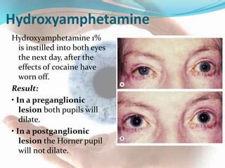 Hydroxyamphetamine test in horner syndrome. .  <a href=https://redeng.ru/xjzr7yx/y...