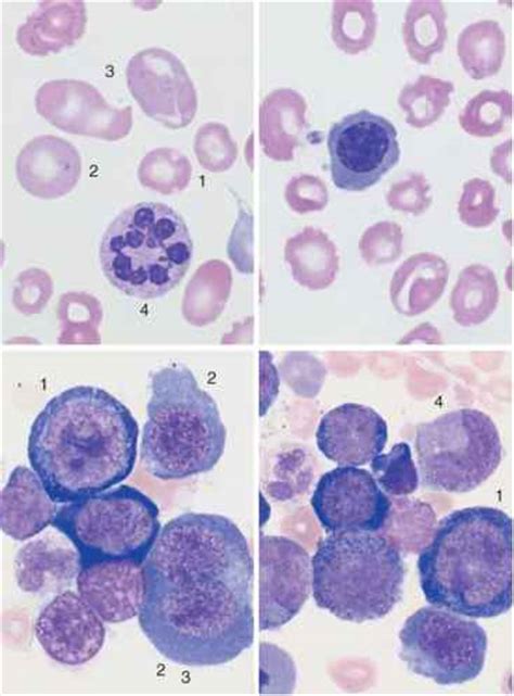 Hyperchromic Anemias - Hematology - Mussen …