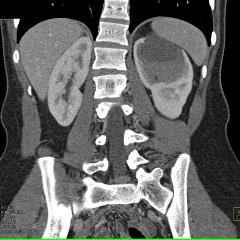 Hyperdense renal masses: a CT manifestation of hemorrhagic renal cysts …