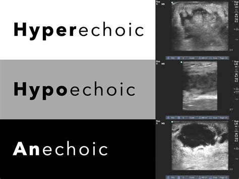 Hyperechoic ultrasound example.  Isoechoic vs.  The third layer is In general imag...