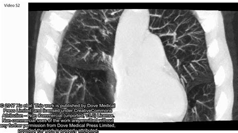 Hyperinflated lungs compress the heart during expiration in COPD ...