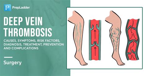 Hyperlipidemia: A novel etiologic factor in deep vein thrombosis