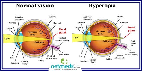 Hypermetropia : Facts, onset, types, diagnosis,