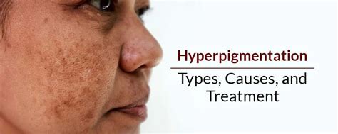 Hyperpigmentation Types treatment and causes