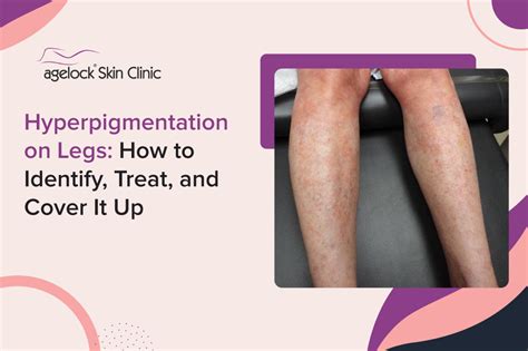 Hyperpigmentation on legs.  Hyperpigmentation is a condition characterized by the d...