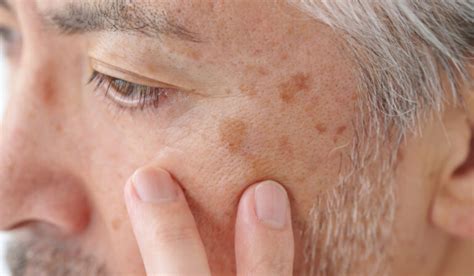 Hyperpigmentering kropp