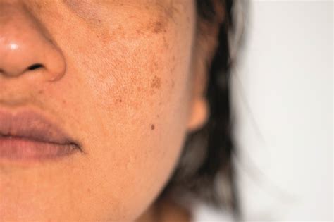 Hyperpigmentering underlivet