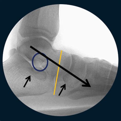 Hyperpronation - very common feet problem nowadays