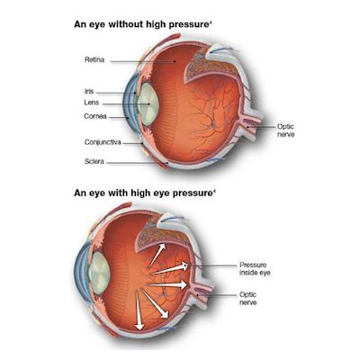 Hypertension and the eye - PubMed