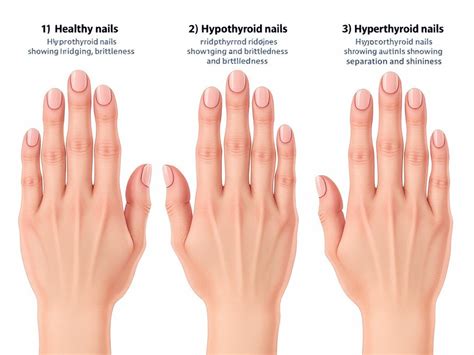 Hyperthyroidism nails. .  This separation is often While hypothyroidism causes nails to be britt...