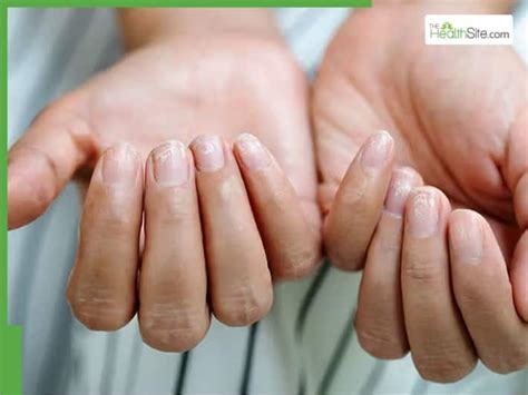 Hyperthyroidism thyroid nails.  Untreated or undertreated hypothyroidism can lead to various...