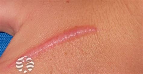 Hypertrophic scar. .  <a href=http://utp174.ru/gvmwsm4/vw-beetle-engine-for-...