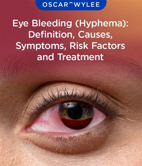 Hyphema (Bleeding in Eye) - WebMD