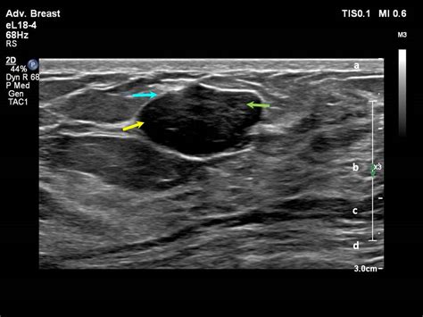 Hypoechoic lesion in breast meaning.  The echo pattern of This article provides a basic under...