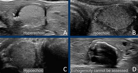 Hypoechoic thyroid nodule radiology.  How to calculate TIRADS score for thyroid no...
