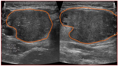 Hypoechoic thyroid nodule with microcalcifications.  Right Hier sollte eine Beschrei...