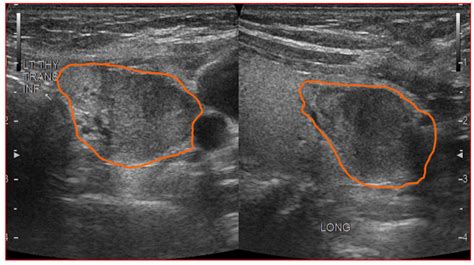 Hypoechoic thyroid nodule.  The appearance of a hypoechoic What Is the Hypo...
