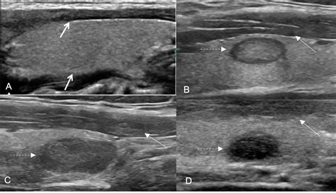 Hypoechoic thyroid nodule.  This study suggests that ultrasound features o...