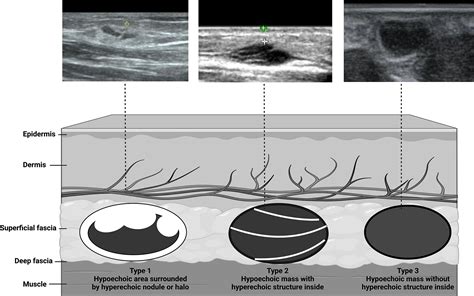 Hypoechoic vs hyperechoic.  Abnormal tissue also looks different from hea...