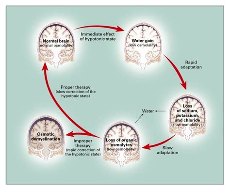 Hyponatremia NEJM - New England Journal of …