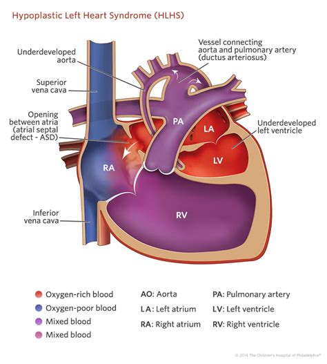 Hypoplastic Left Heart Syndrome (HLHS) Children