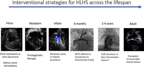 Hypoplastic Left Heart Syndrome Across the Lifespan: Clinical ...