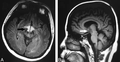 Hypothalamus Syndrome in Opticospinal Multiple Sclerosis