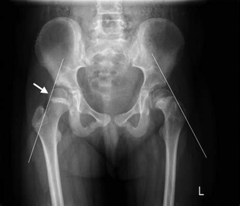 Hypothyroidism Presenting as Slipped Capital Femoral Epiphysis