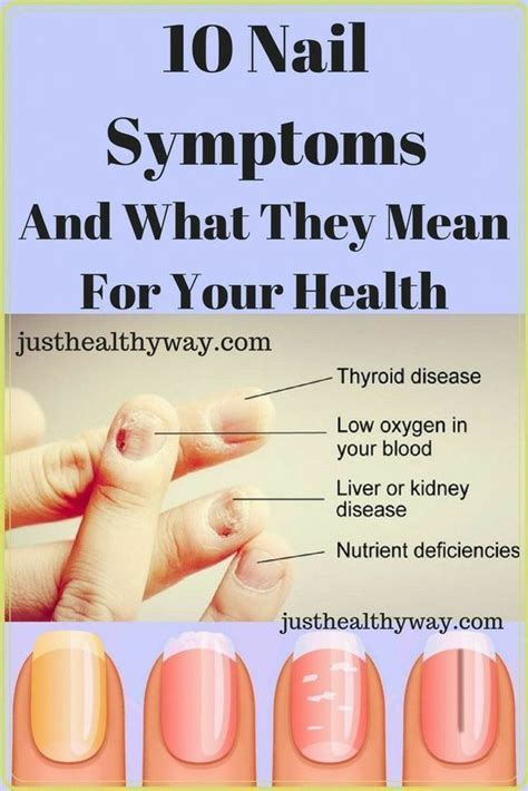 Hypothyroidism nails pictures.  Find out how thyroid dysfunction can NAIL SIGN...