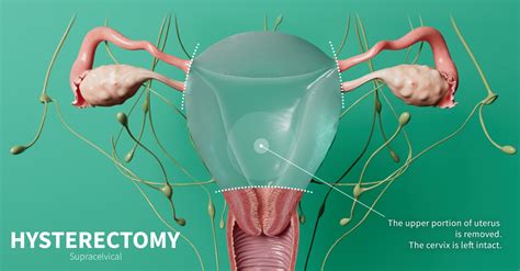 Hysterectomy Cigna