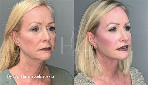 HZ Plastic Surgery. 4,683 likes · 181 talking about this · 189 were here. HZ Plastic Surgery in Orlando offers surgical and non-invasive options for the body, breast, and face to deliver beautiful,.... 