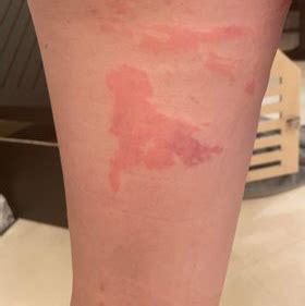 I Got a Second-Degree Burn from Waxing - Shape