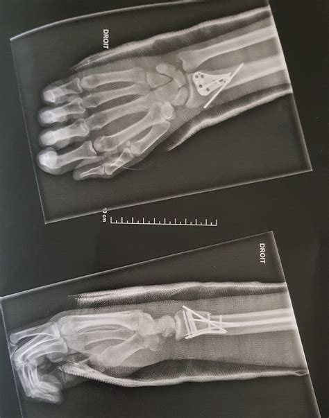 I fell on my wrist about 7 months ago: i slipped and used my hand …