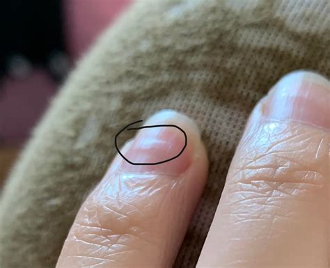 I have a horizontal bump on my left thumbnail that just …