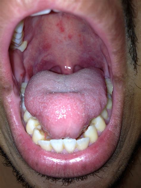 I have what appears to be a black spot under my tongue - JustAnswer