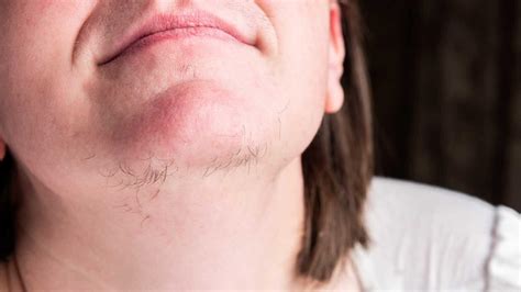 I have white hairs on my chin, upper lip and sides of my face.