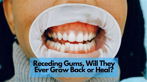 I healed my receding gums. Things To Know About I healed my receding gums. 