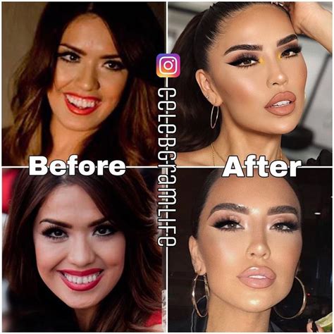 I love sarahii before surgery. If you have had plastic surgery like Iluvsarahii before and would like: Quickly resume your normal life after Iluvsarahii Before And After Plastic Surgery; Keep the plastic outcome for a very long time. Utilize methods of natural rejuvenation and mix them with Iluvsarahii Before And After Plastic Surgery in both situations. 