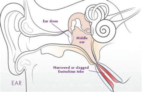 I suffer from Patulous Eustachian Tube - My Life In Neon