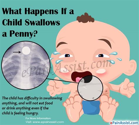 I swallowed a penny Stomach problems discussions Body